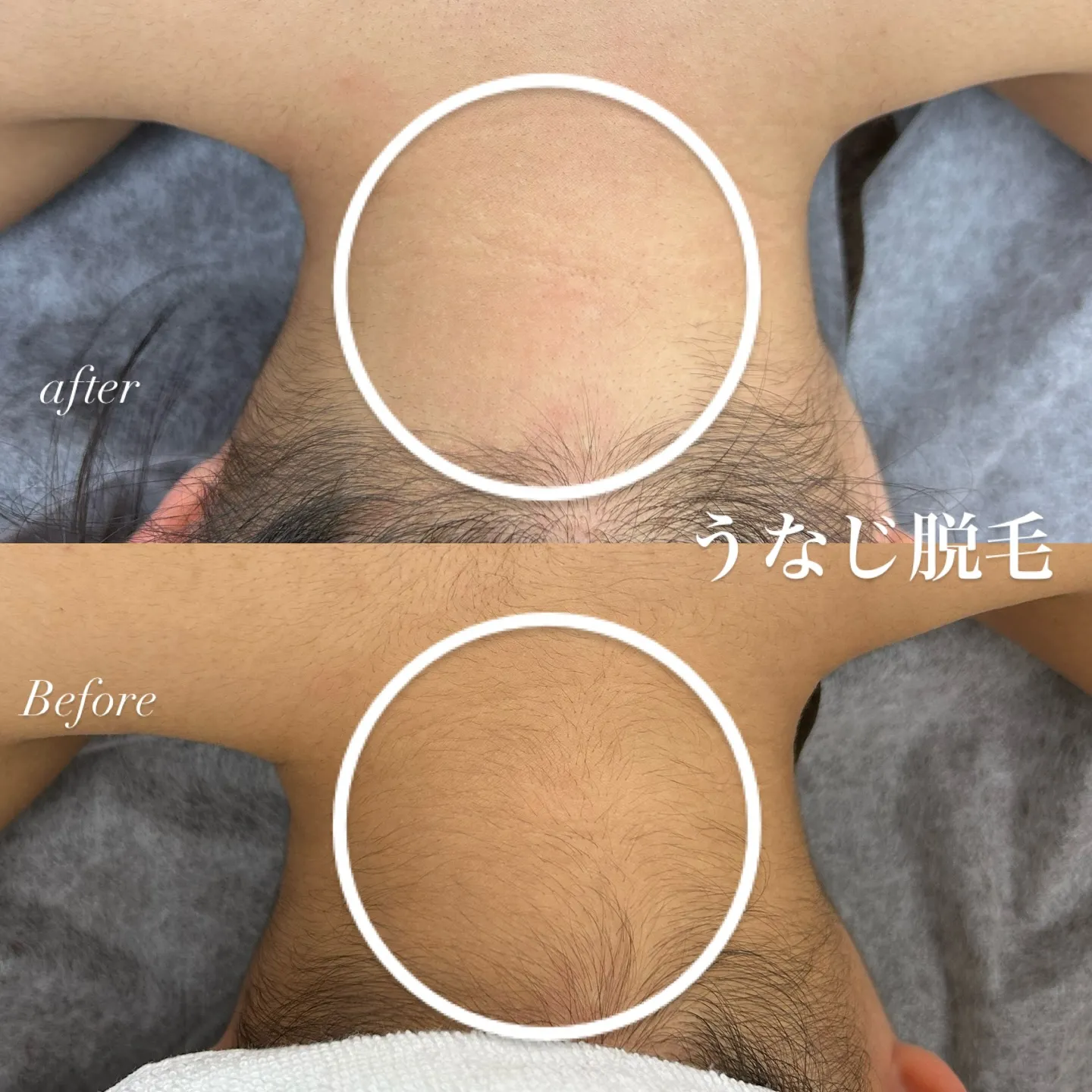 【うなじ脱毛★明石/舞子/垂水区】