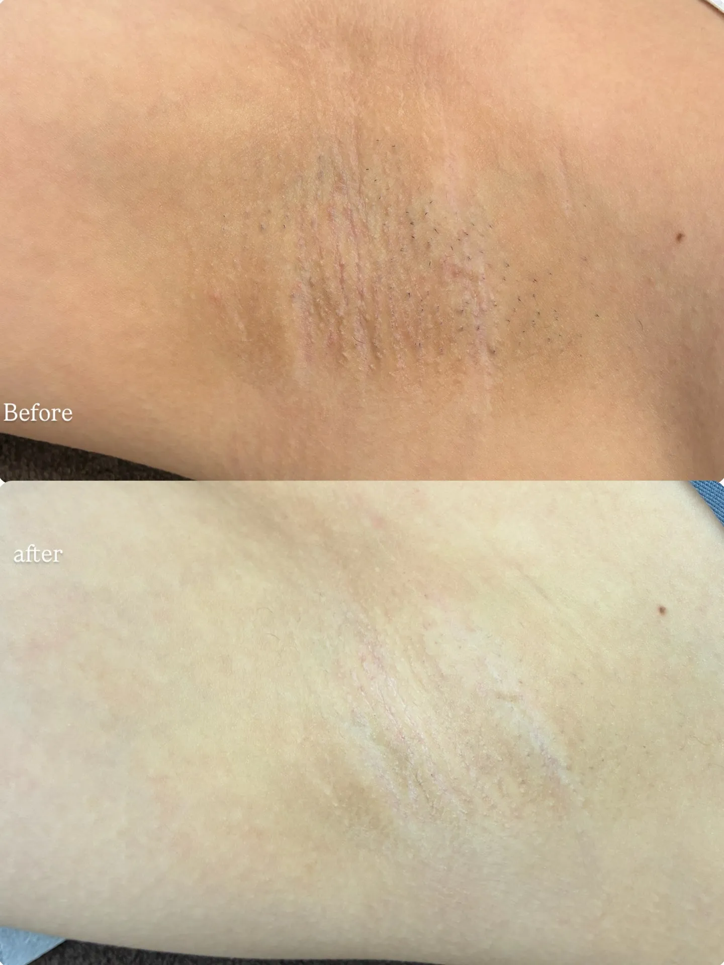 【脇脱毛Before/after 垂水区の都度払い脱毛サロン...